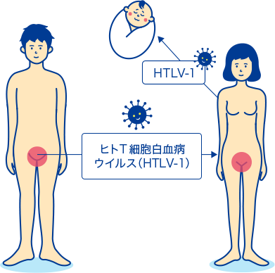 成人T細胞白血病の解説 症状や感染経路・検査や治療について│STD研究所